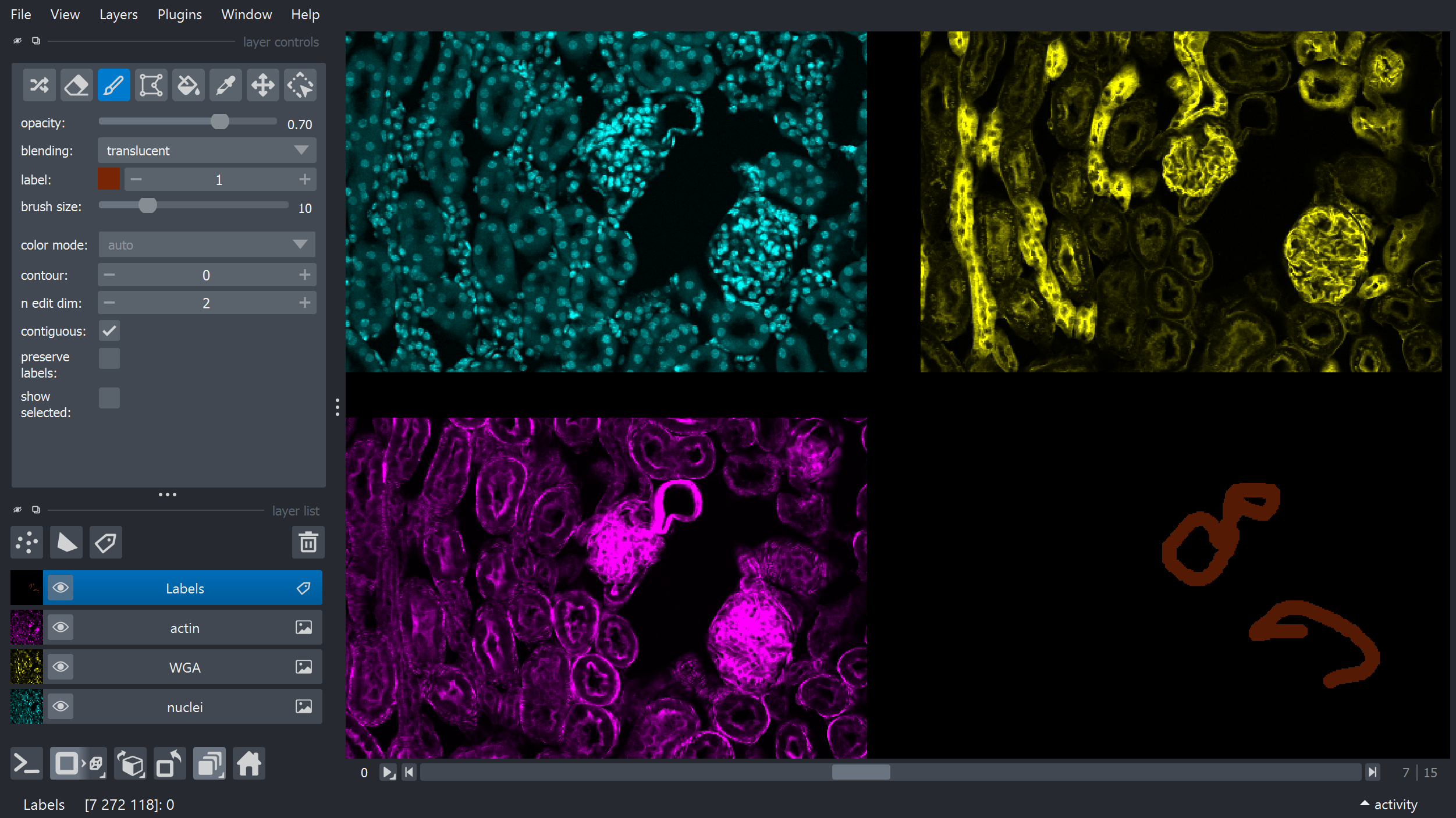 a screen recording showing the the Kidney example toggling between normal mode and grid mode